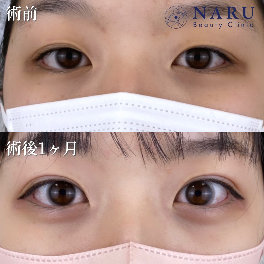 10代女性　二重埋没法