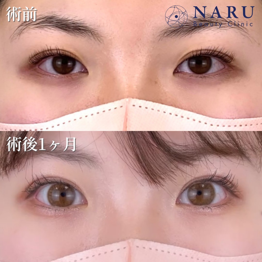 20代女性　二重埋没法