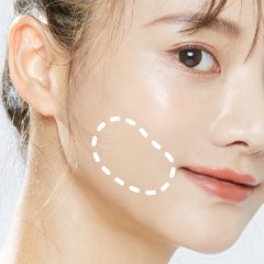 バッカルファット除去