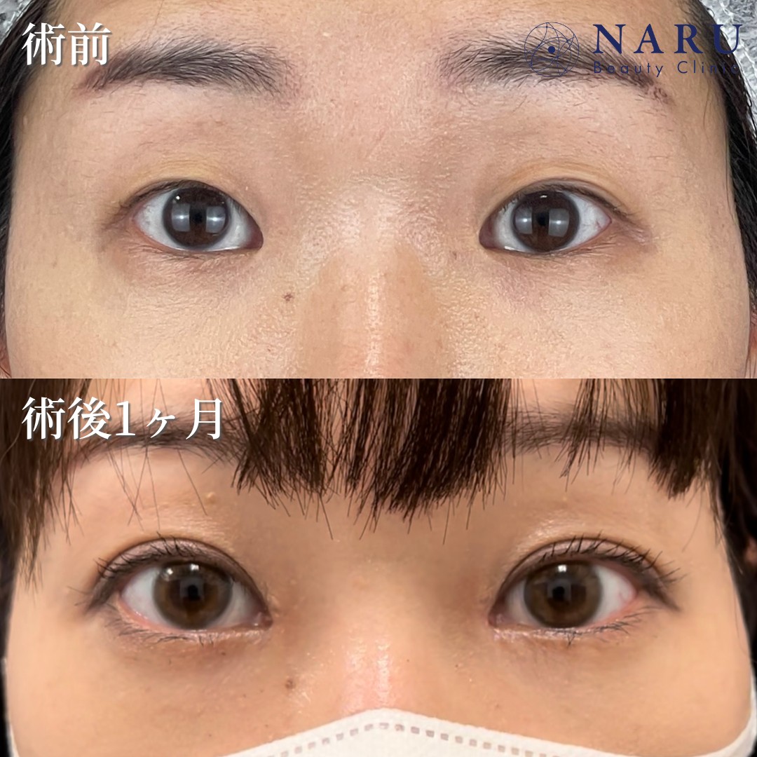 目頭切開ビフォーアフター