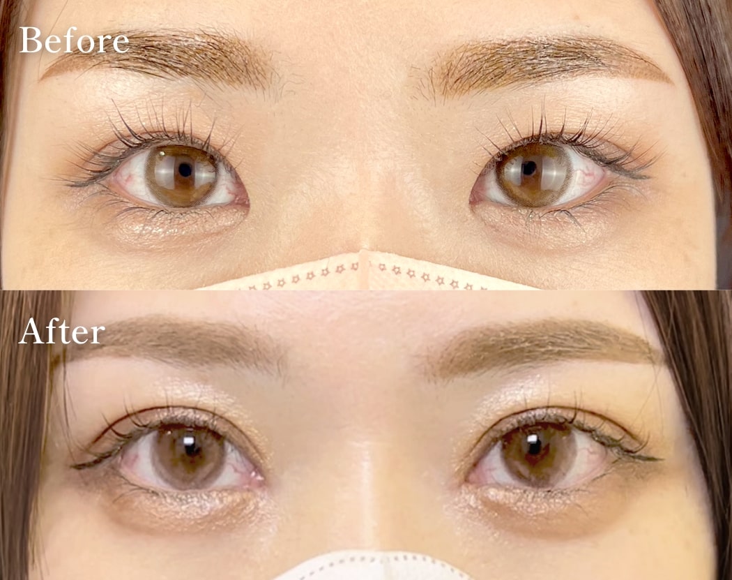 目頭切開ビフォーアフター