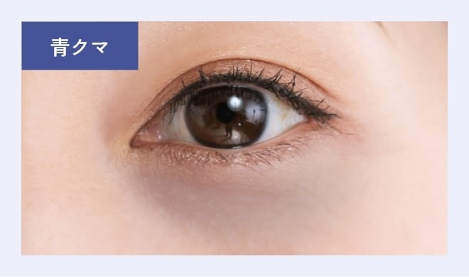 目の下の青いクマ