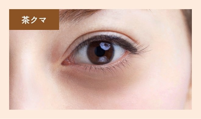 目の下の茶色いクマ