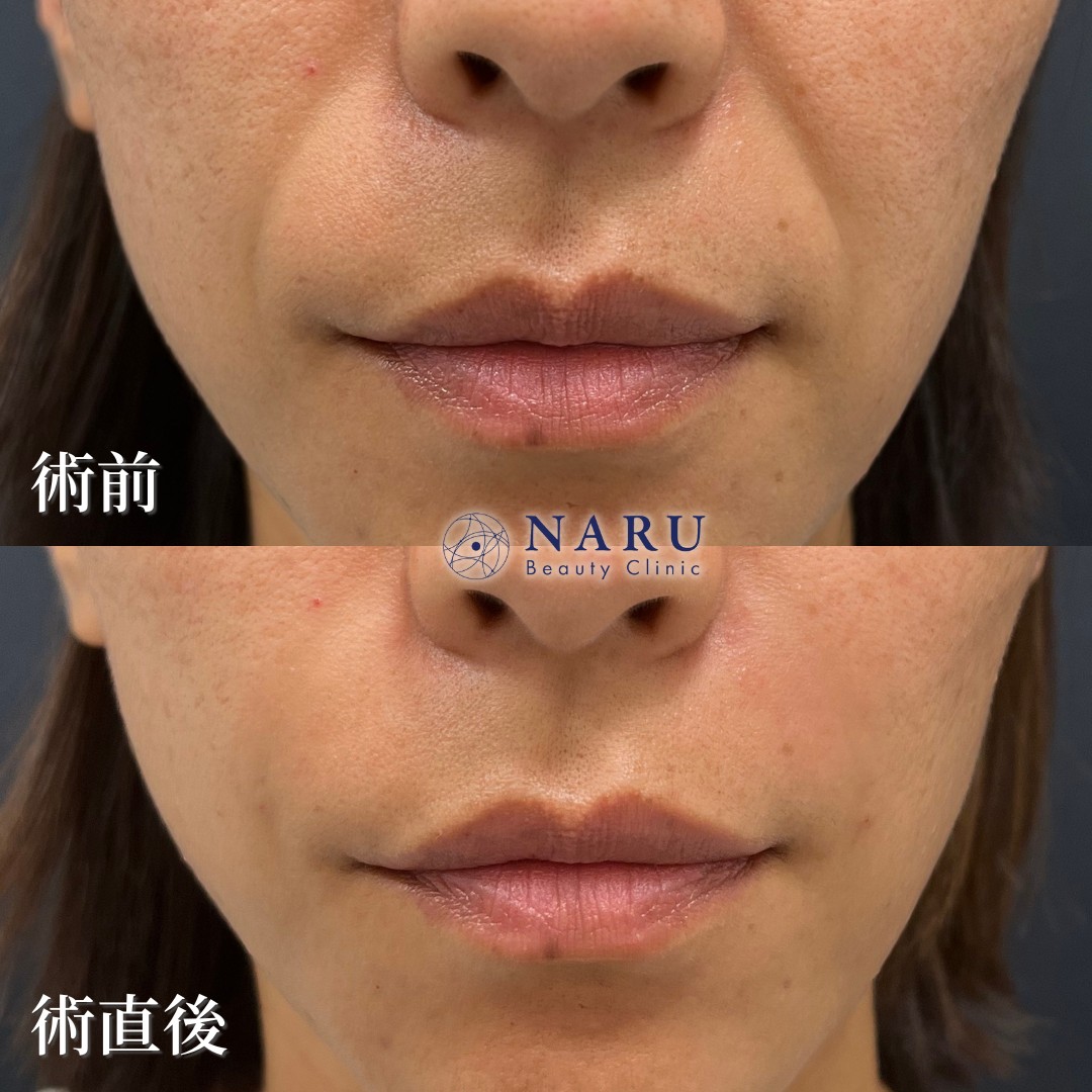 30代女性　ほうれい線ヒアルロン酸