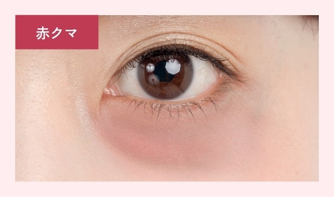 目の下の赤いクマ