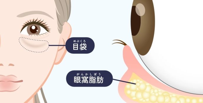 皮膚のたるみや目元の膨らみ