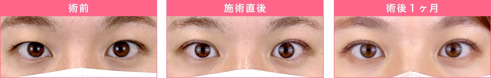 施術前、直後、術後1ヶ月の経過写真PC