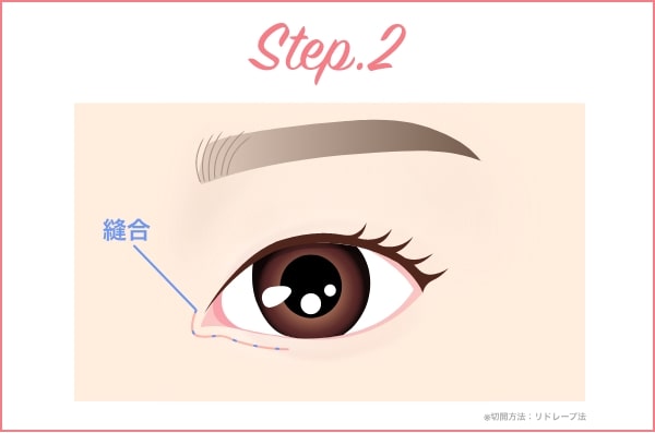 目頭切開ステップ2