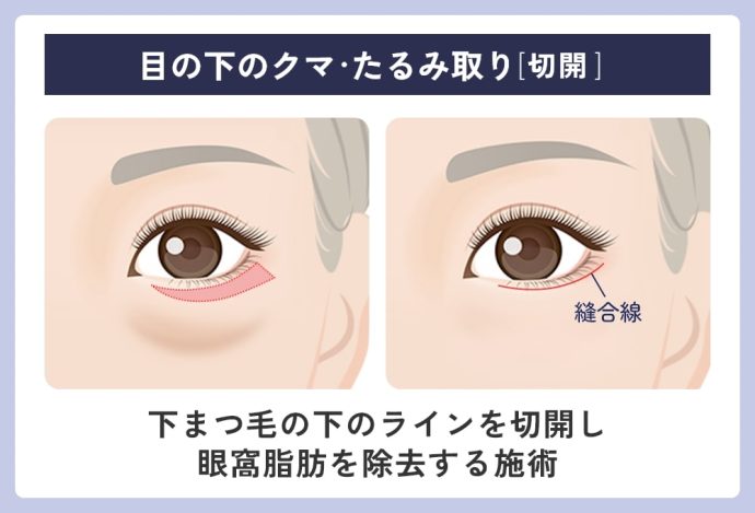 目の下のクマ・たるみ取り