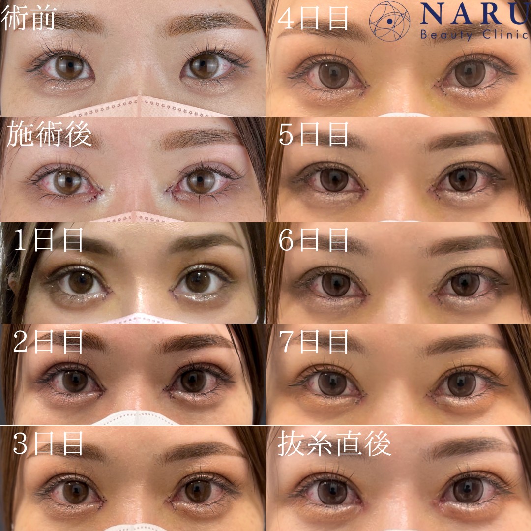 目頭切開ダウンタイム