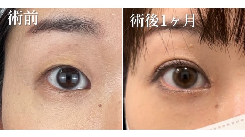 目頭切開選ばれる理由01