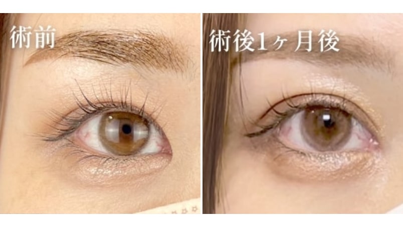 目頭切開選ばれる理由02