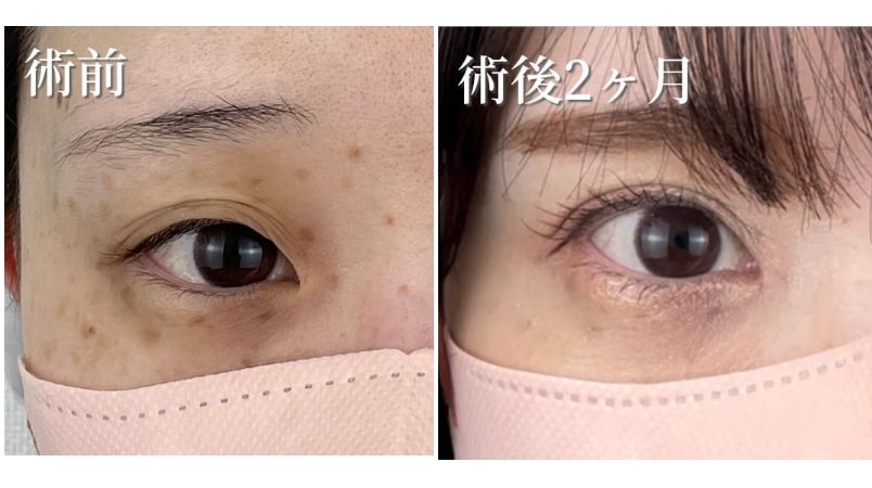 目頭切開選ばれる理由03