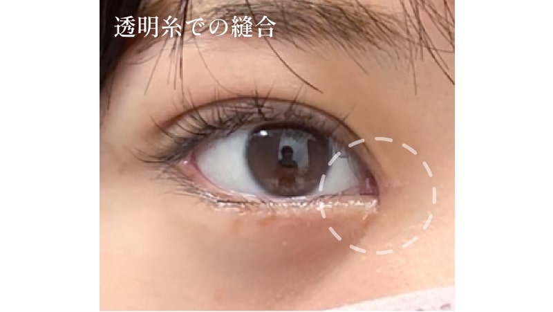 目頭切開選ばれる理由04