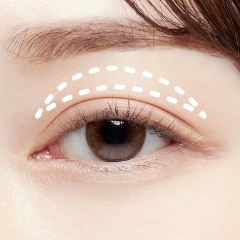 上まぶたの脂肪取り