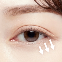 グラマラスライン形成（たれ目形成）