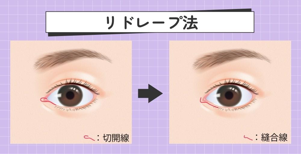 レドリープ法の説明図