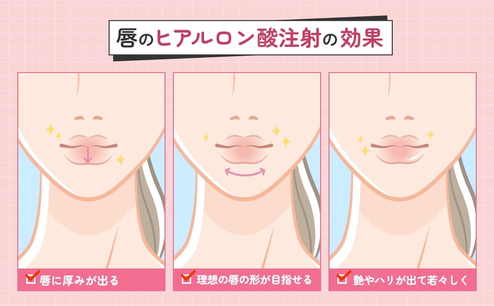 唇のヒアルロン酸注射の効果