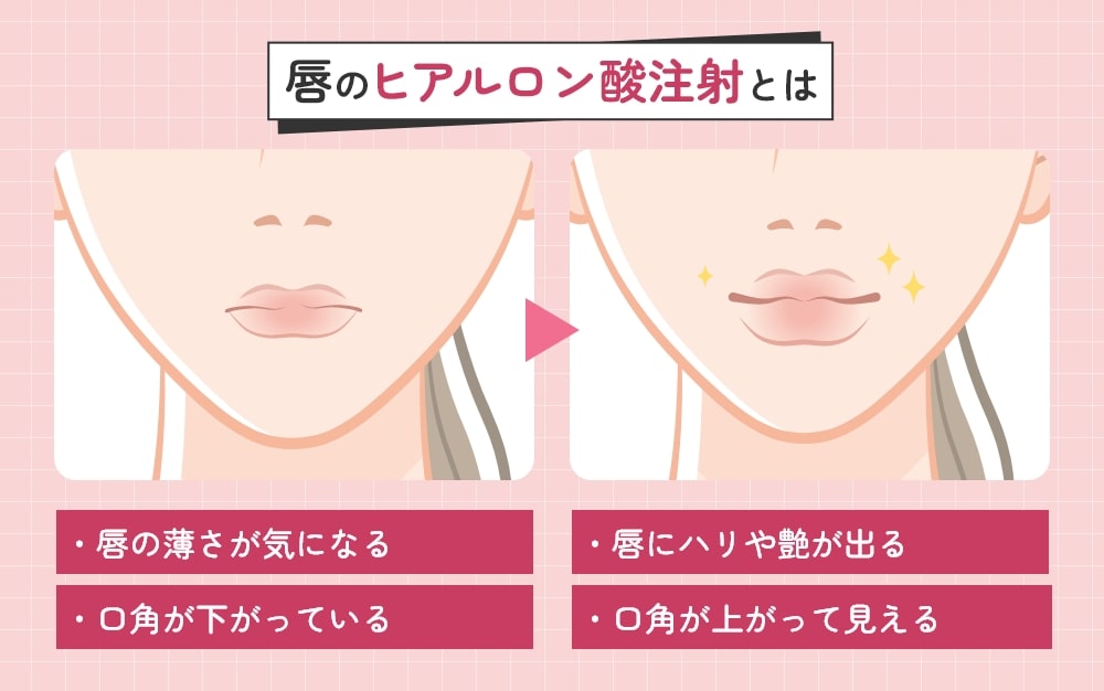 唇のヒアルロン酸注射とは