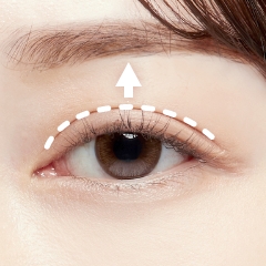 切らない眼瞼下垂(挙筋前転法)
