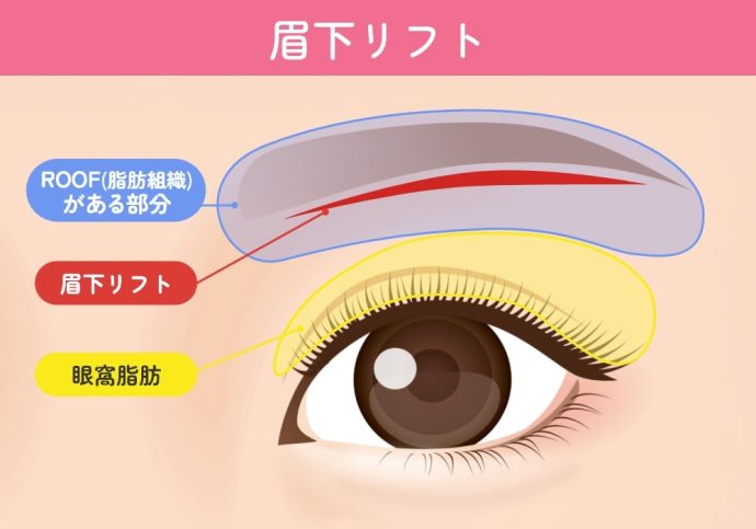眉下リフト