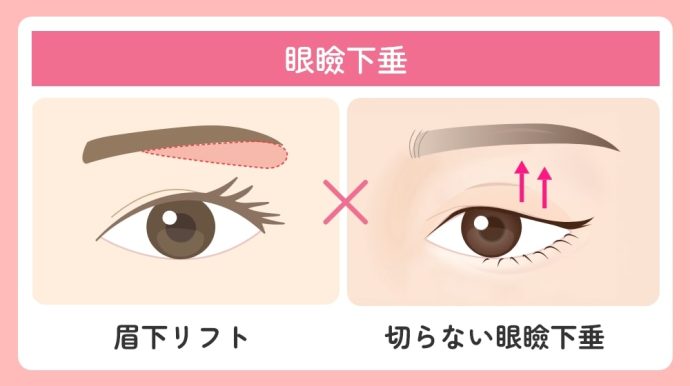 眼瞼下垂