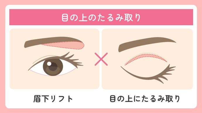 目の上のたるみ取り