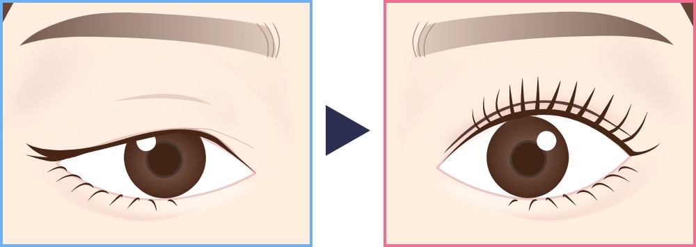上まぶたの脂肪を除去