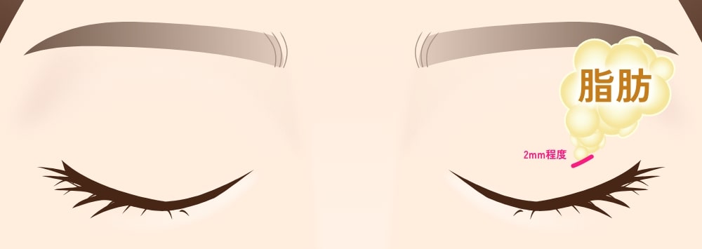 上まぶたの脂肪取り