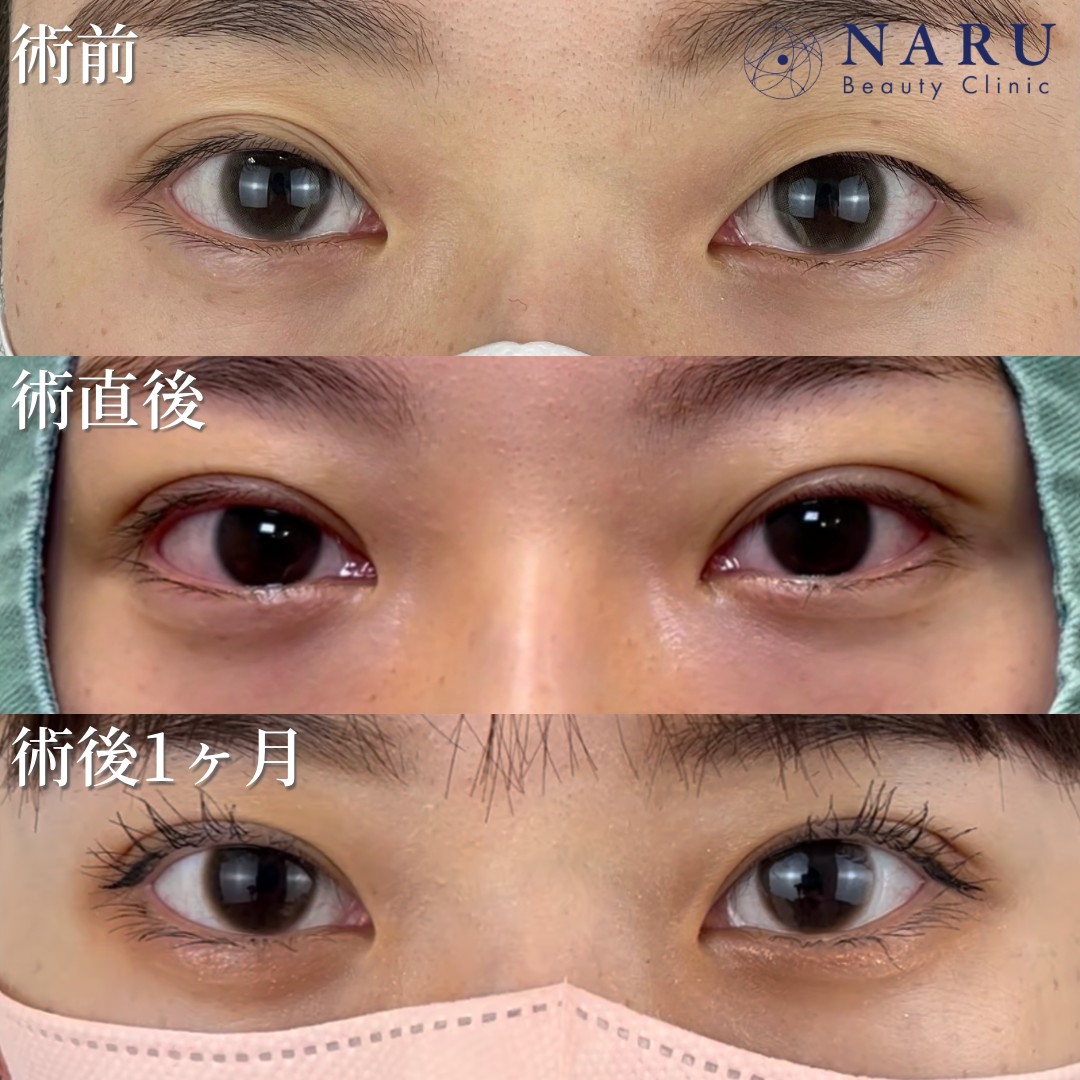 20代女性　二重埋没法