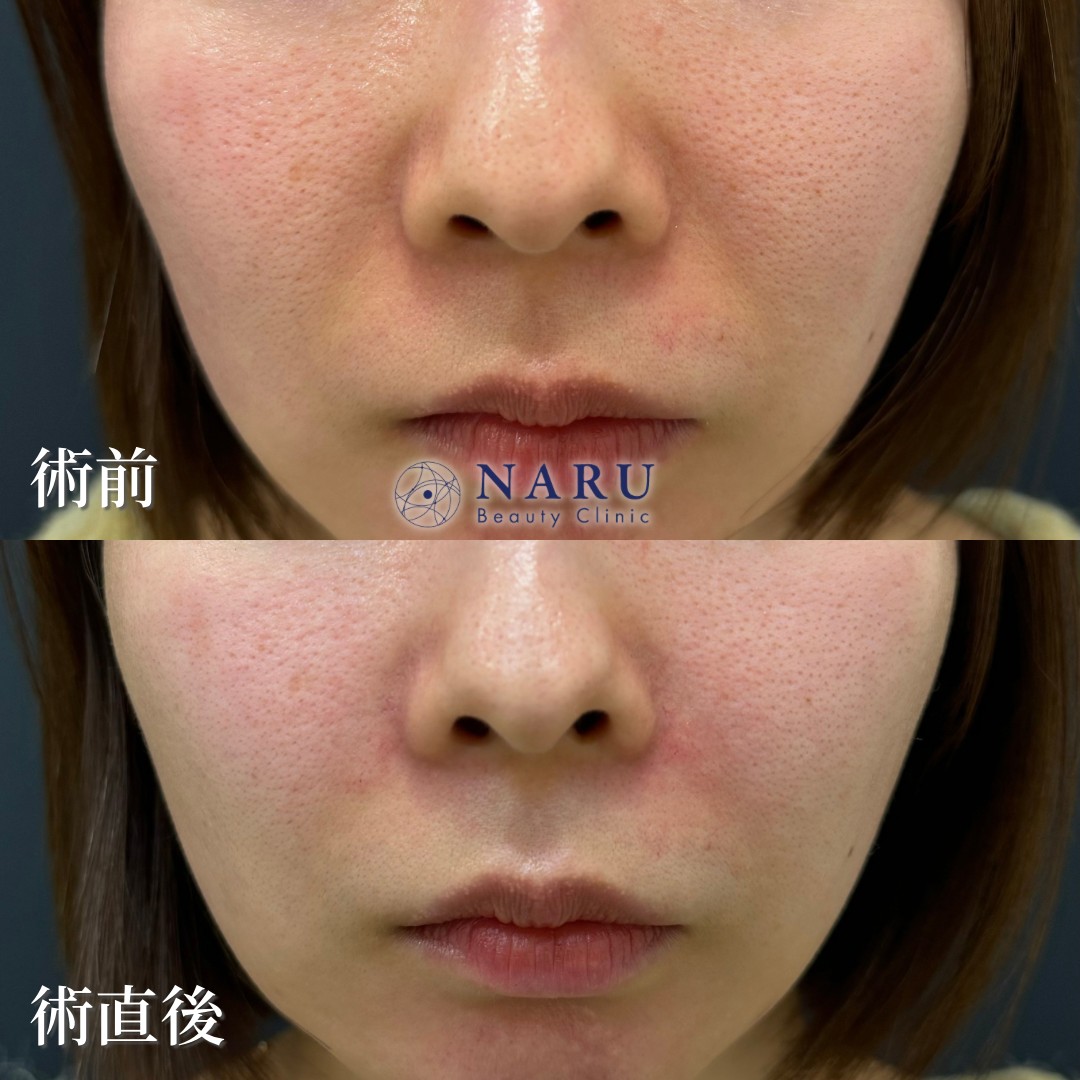 20代女性　貴族ヒアルロン酸