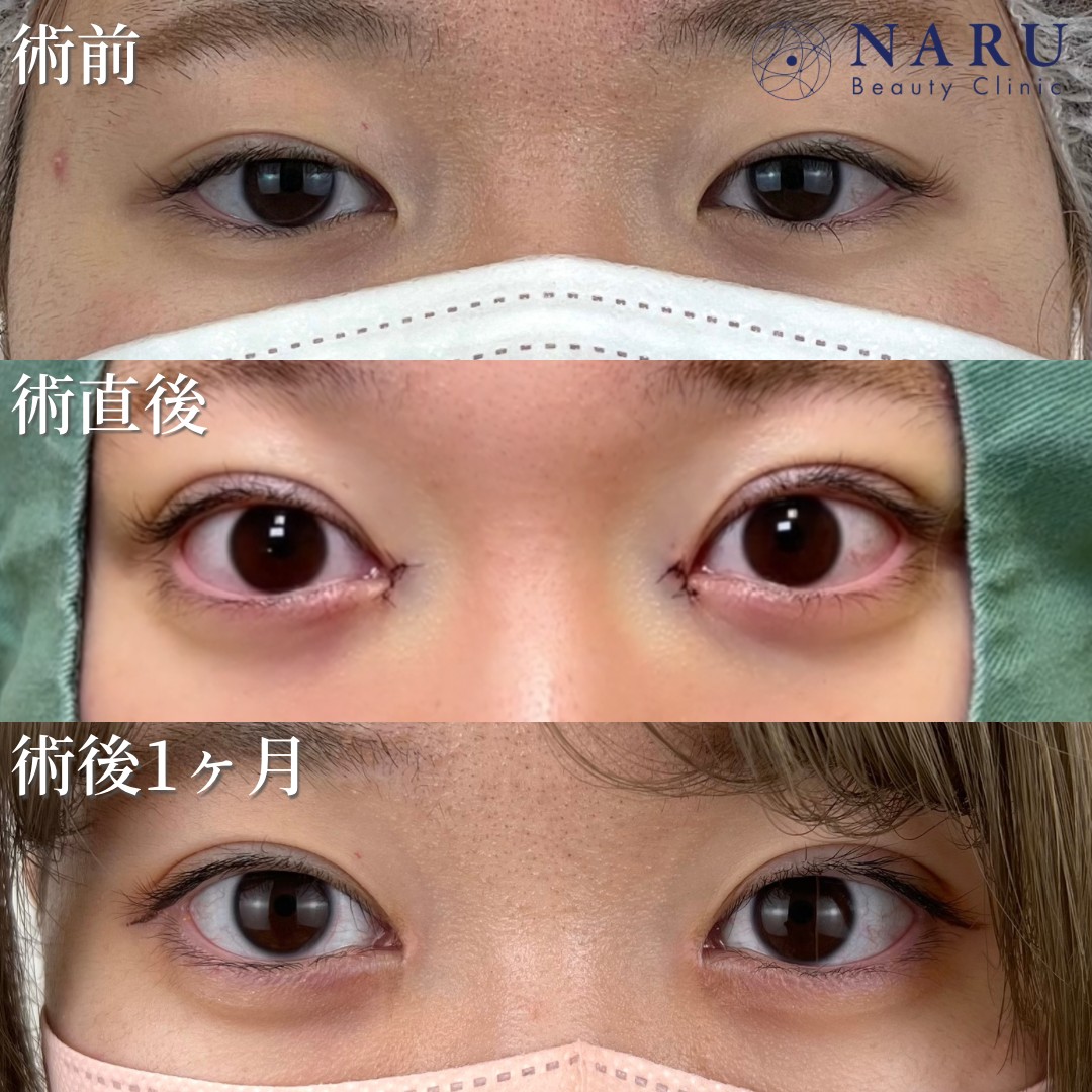 10代女性　二重埋没法＋目頭切開