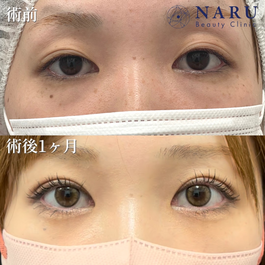 20代女性　二重埋没法＋クマ取り