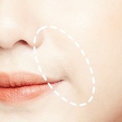 脂肪注入ほうれい線