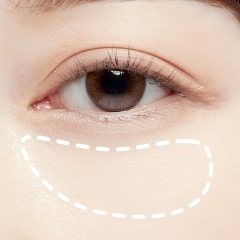 脂肪注入目の下