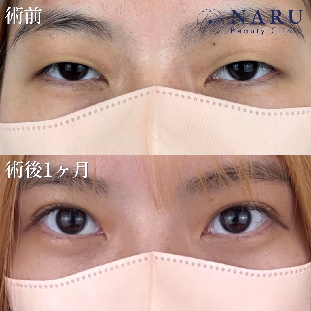 10代女性　二重埋没法