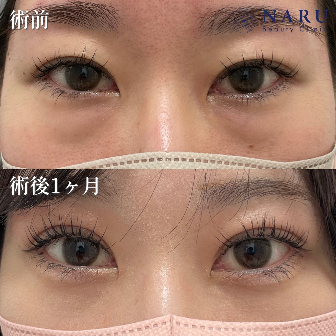 20代女性　二重埋没法＋クマ取り