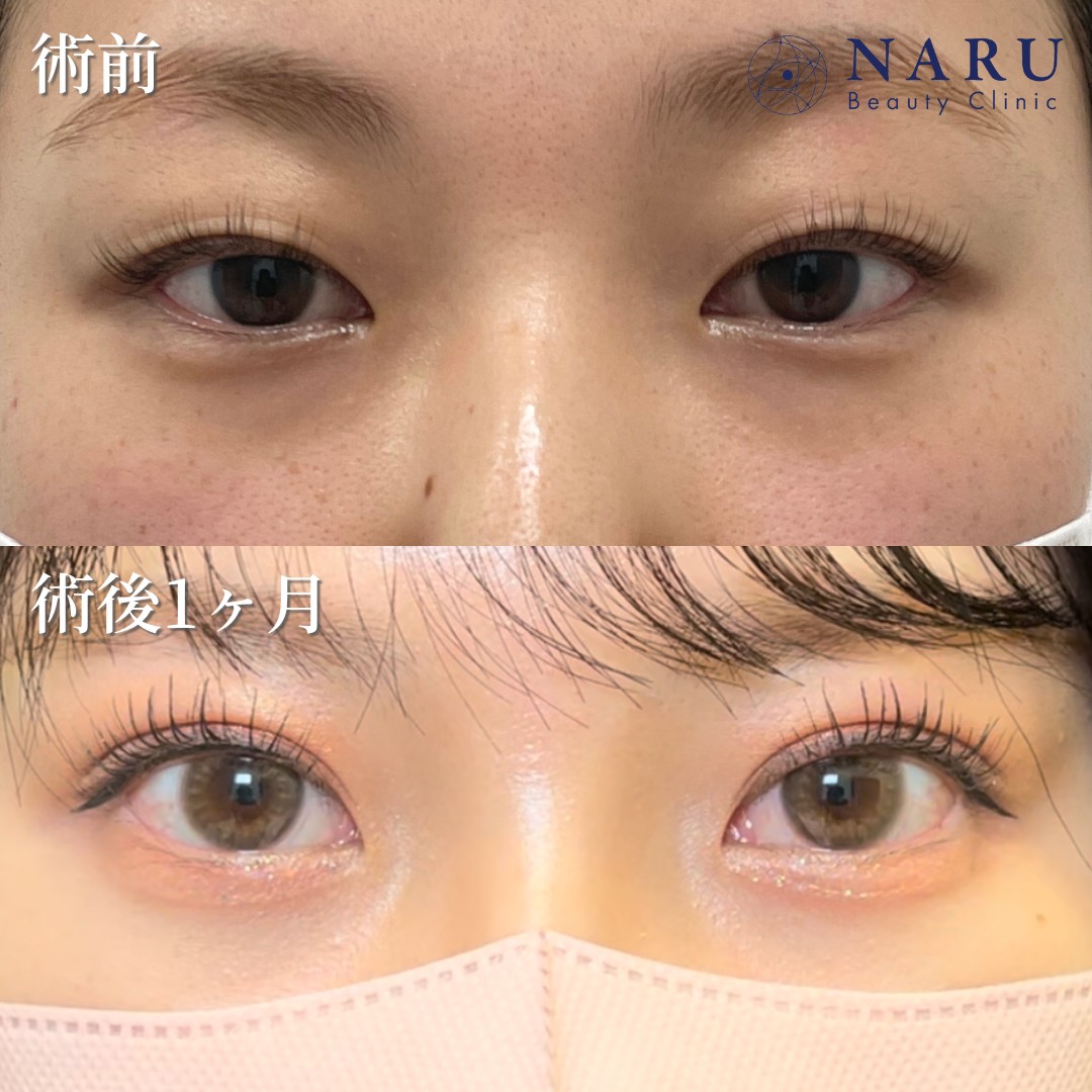 20代女性　二重埋没法＋クマ取り