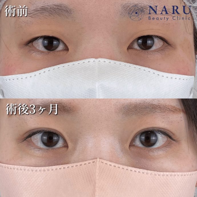 ナルクリスクエア症例写真01