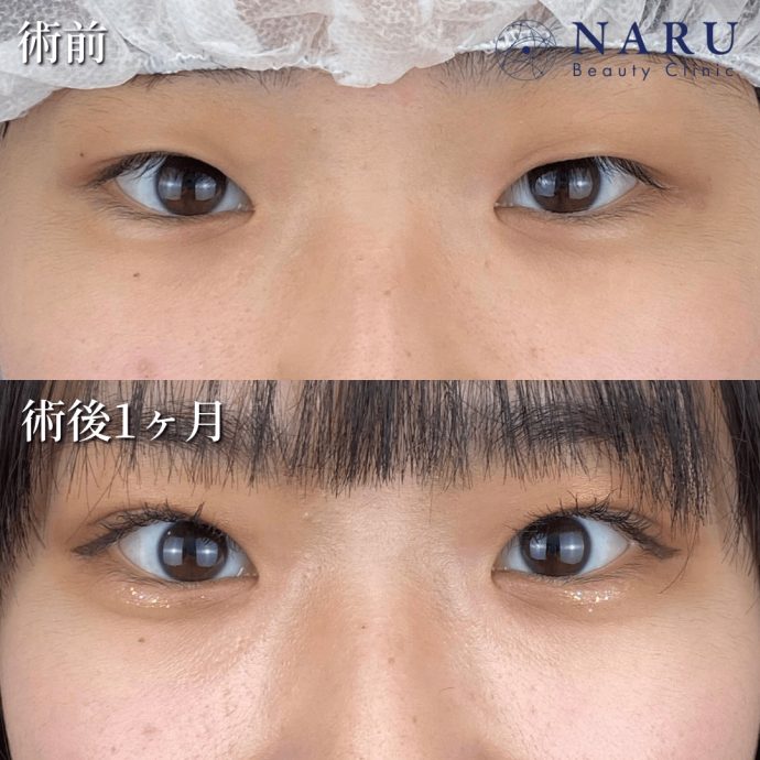 ナルクリ二重術症例写真02