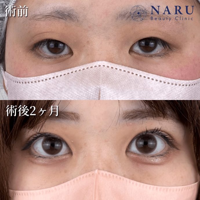 ナルクリ二重術症例写真01