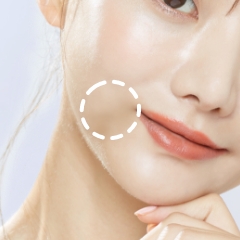 ジョールファット(口角横)脂肪吸引