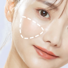 メーラーファット(頬骨上)脂肪吸引