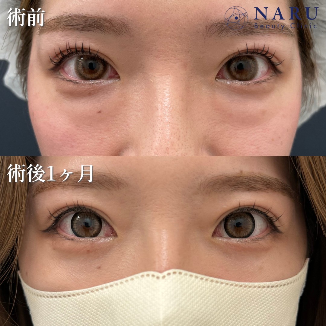 30代女性　クマ取り