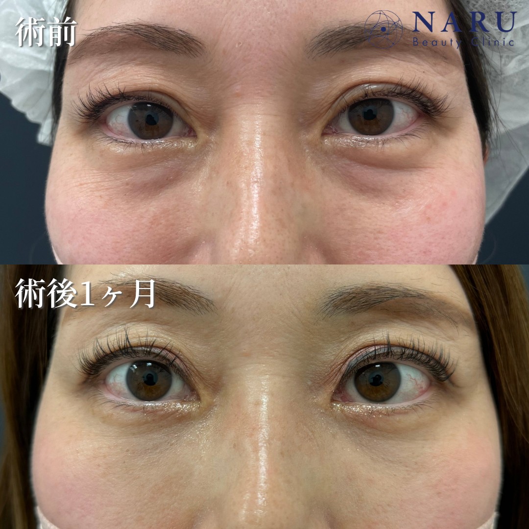 40代女性　クマ取り