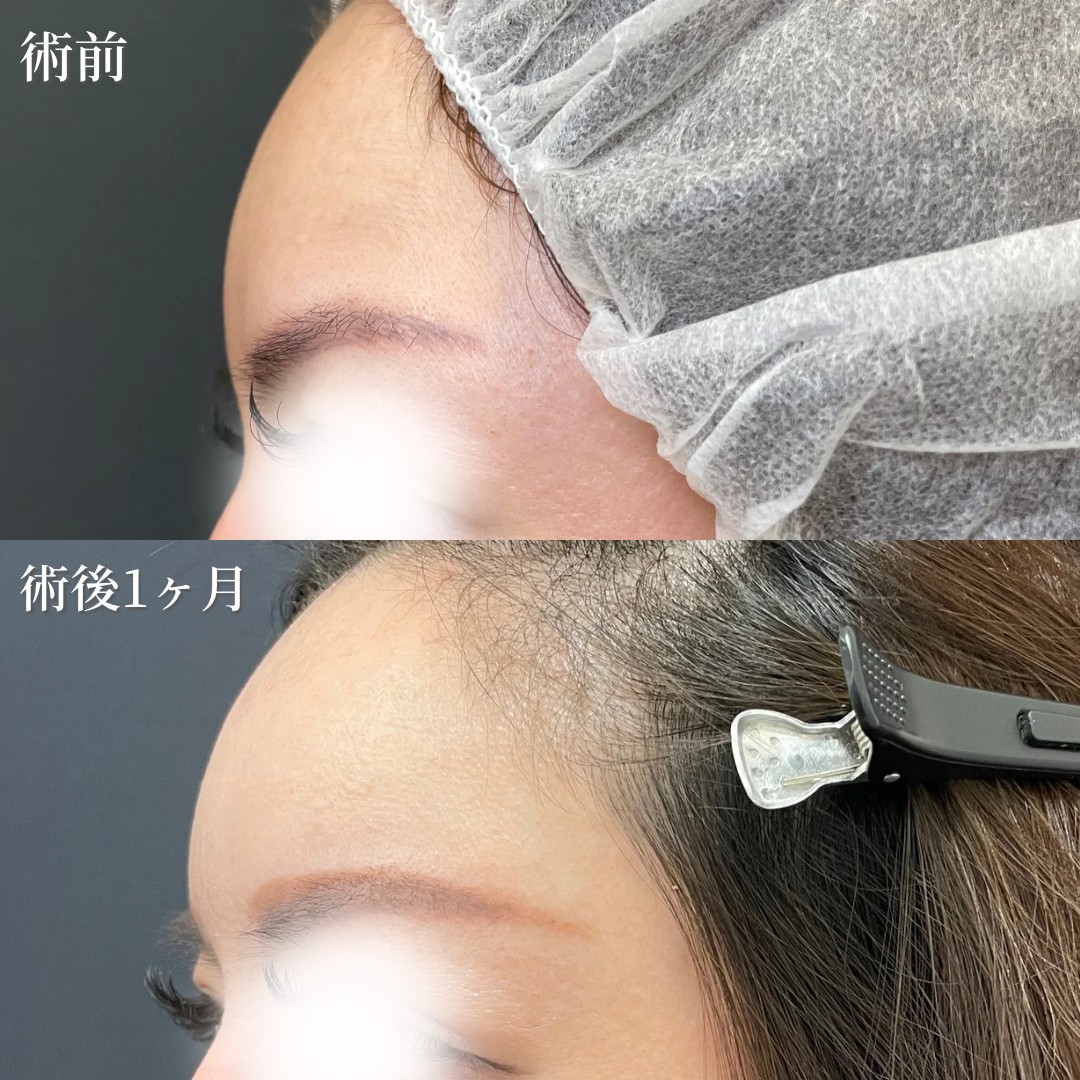 40代女性　額脂肪注入