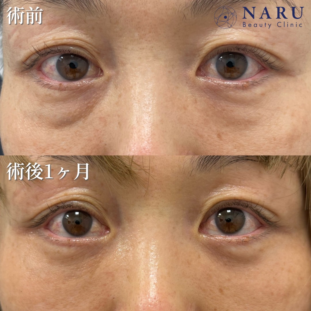 40代女性　クマ取り＋脂肪注入