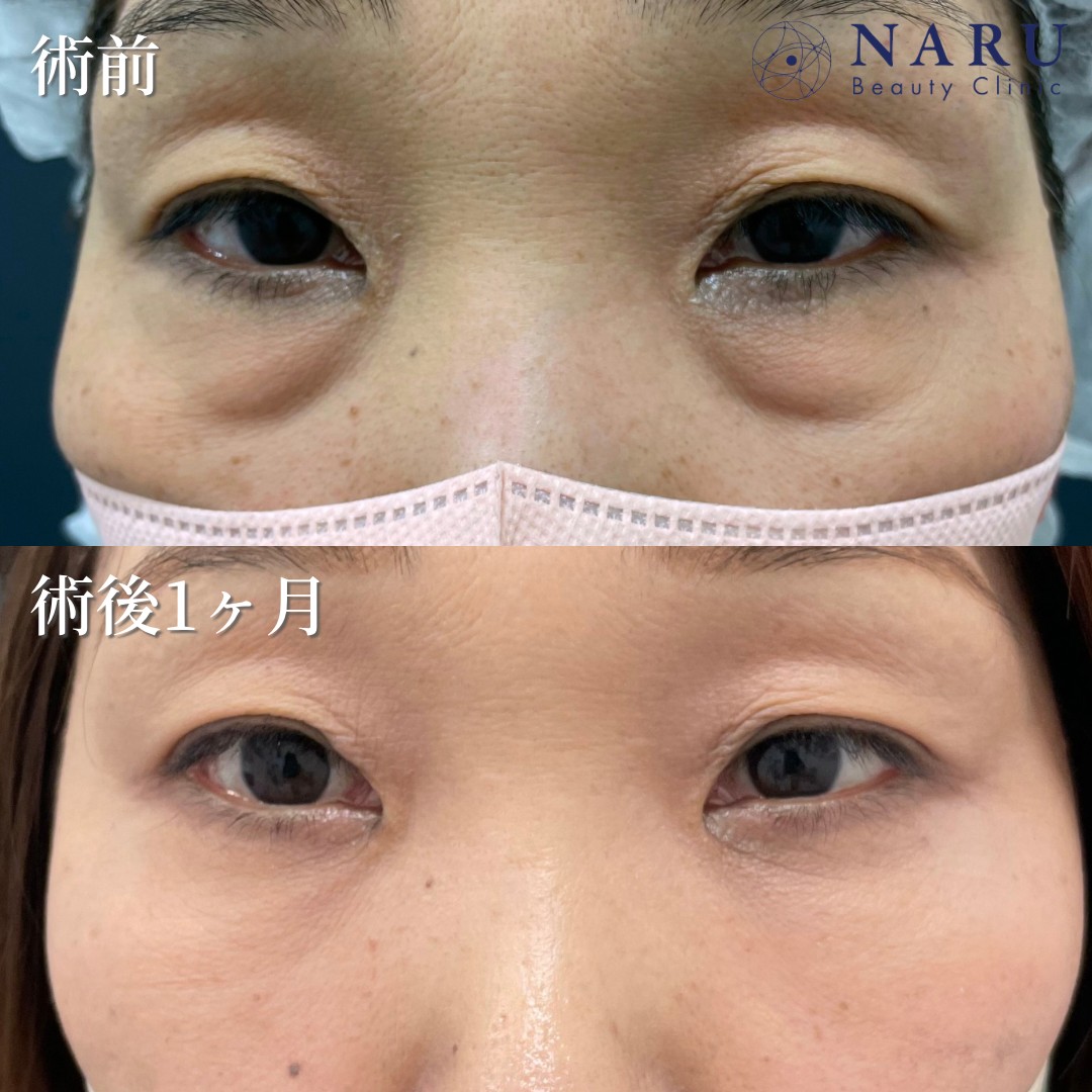 50代女性　クマ取り＋脂肪注入