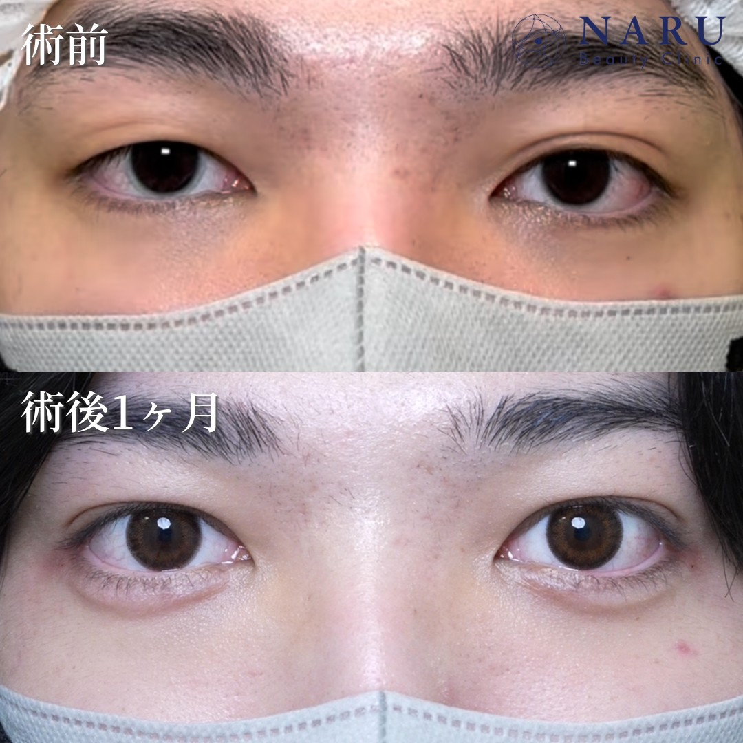 10代男性　二重埋没法＋涙袋ヒアルロン酸