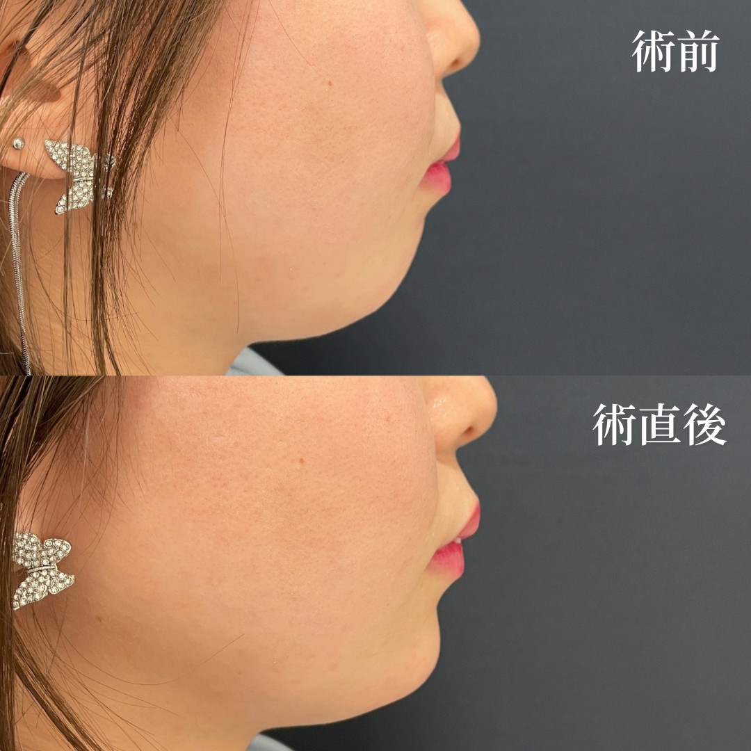 10代女性　顎ヒアルロン酸